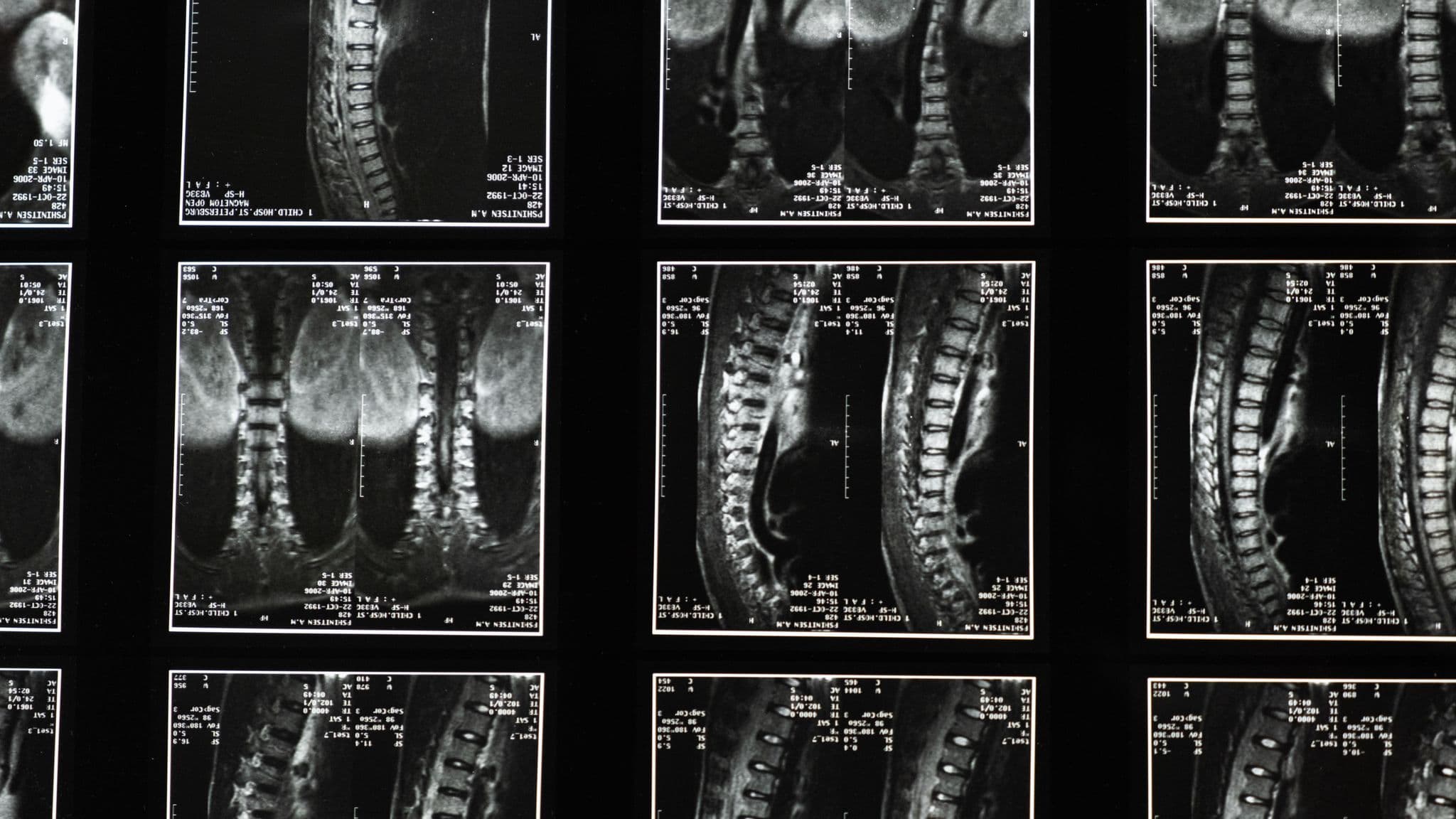 Spinal imaging films on a lightbox